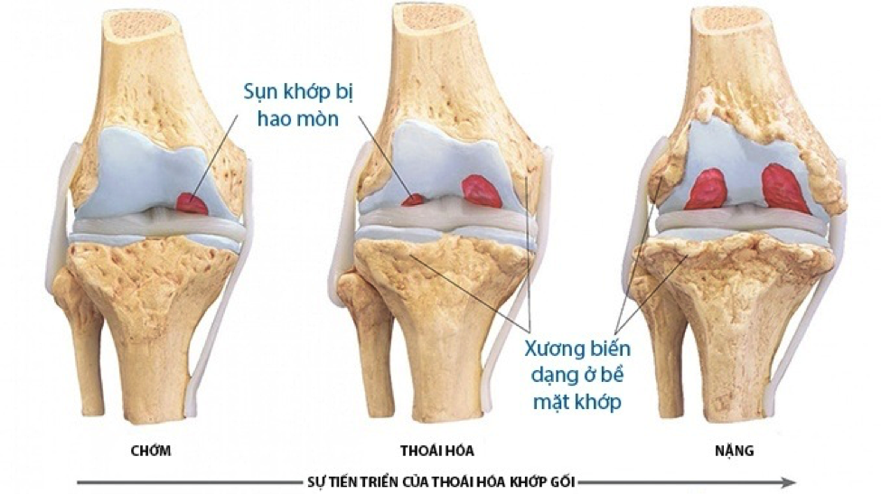 Phương pháp điều trị hiệu quả cho bệnh thoái hóa khớp gối