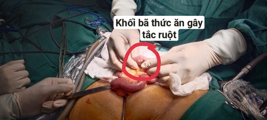 Bệnh viện đa khoa huyện Mê Linh phẫu thuật thành công ca tắc ruột do bã thức ăn ở người bệnh cao tuổi