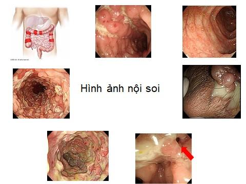 Bệnh Crohn