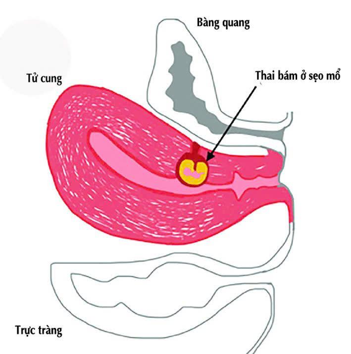 Bệnh viện Đa khoa Mê Linh kịp thời cấp cứu thành công trường hợp nguy kịch do sốc mất máu / thai tại vết mổ cũ đang sảy