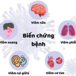 Bệnh cúm A và những biến chứng cần được cảnh giác