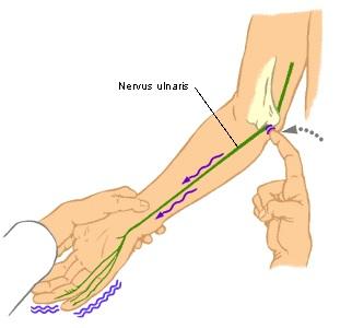 Hội chứng đường hầm Cubital