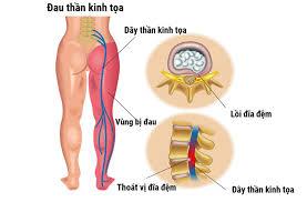 Hội chứng đau thần kinh