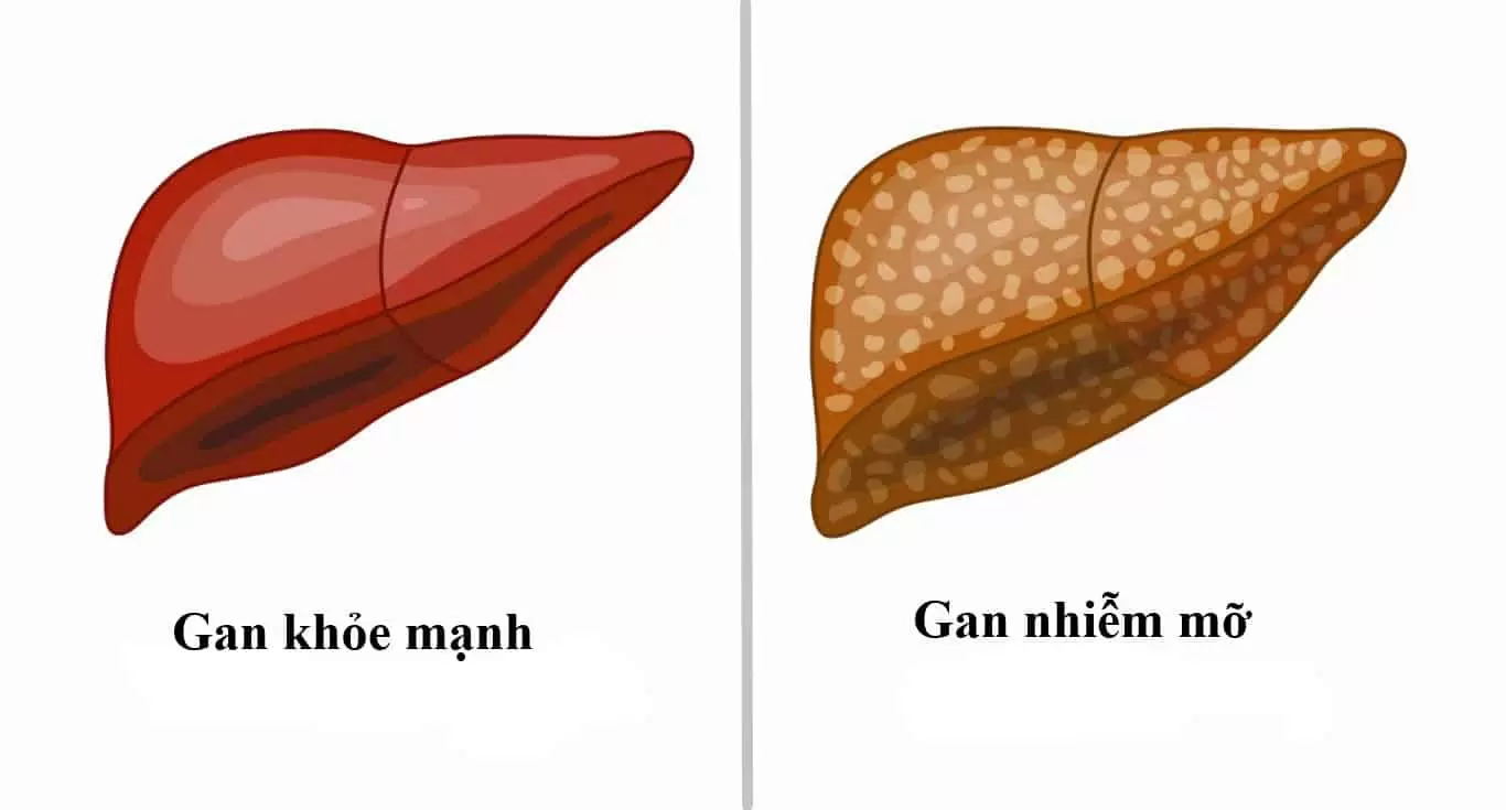 Gan nhiễm mỡ