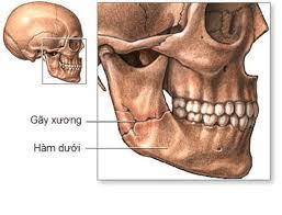 Chấn thương mặt và gãy xương mặt