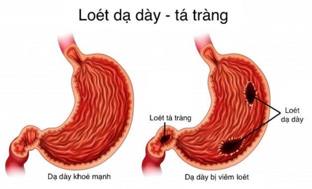 Chứng khó tiêu (Bệnh loét dạ dày tá tràng)