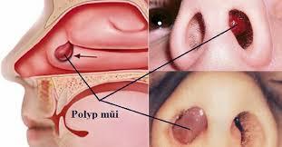 Polyp mũi