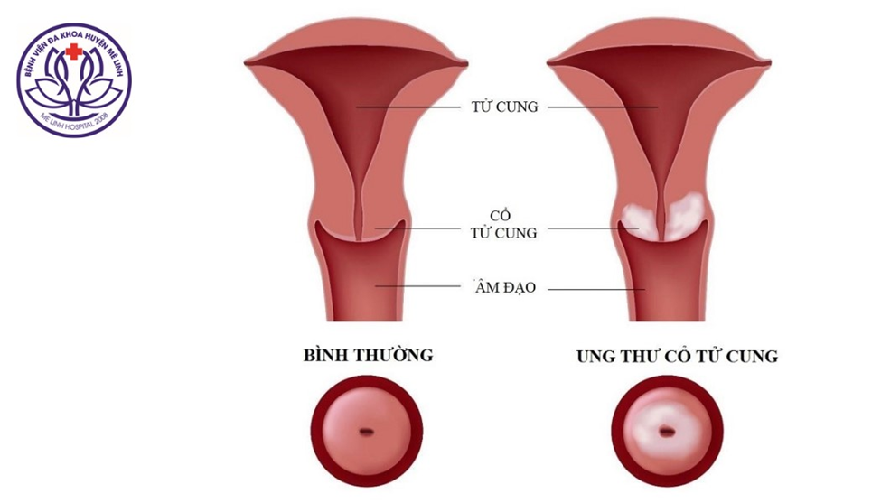 Lợi ích khi tiêm vắc-xin phòng ngừa ung thư cổ tử cung