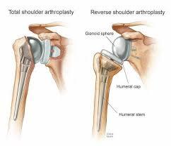 Thay khớp vai toàn phần (Arthroplasty)