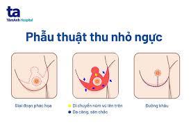 Thu nhỏ ngực