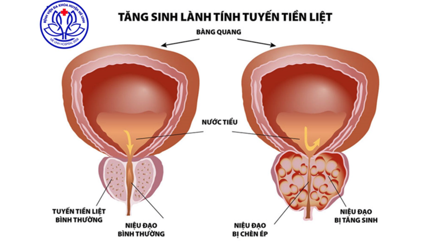 PHẪU THUẬT PHÌ ĐẠI TUYẾN TIỀN LIỆT Ở BỆNH NHÂN CAO TUỔI