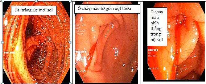 Bệnh viện đa khoa Huyện Mê Linh cấp cứu thành công ca xuất huyết tiêu hóa ruột thừa hiếm gặp