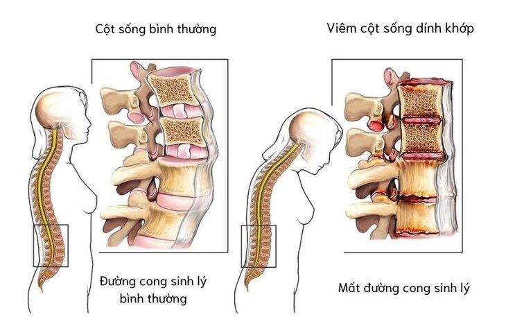 Viêm cột sống