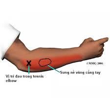 Vai và Khuỷu tay - Khuỷu tay quần vợt/Viêm mỏm lồi cầu bên