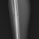 Xử trí thành công ca gãy hở hai xương cẳng chân do tai nạn giao thông