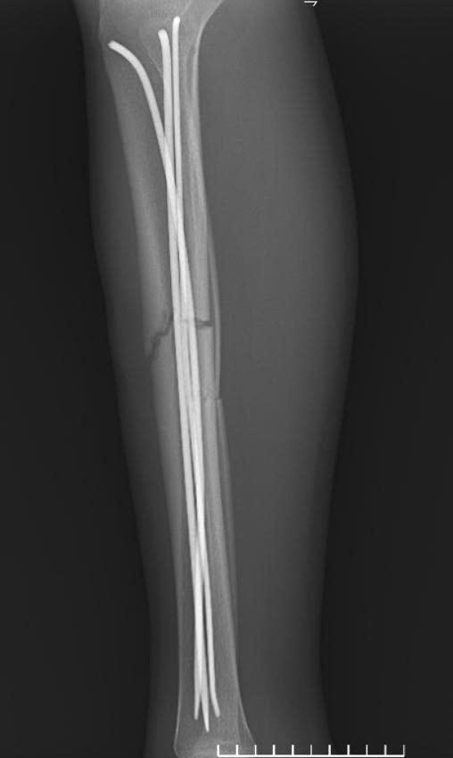 Xử trí thành công ca gãy hở hai xương cẳng chân do tai nạn giao thông