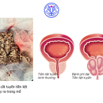 Phẫu thuật cắt tuyến tiền liệt nội soi thành công cho bệnh nhân 88 tuổi tại Bệnh viện Đa khoa Mê Linh